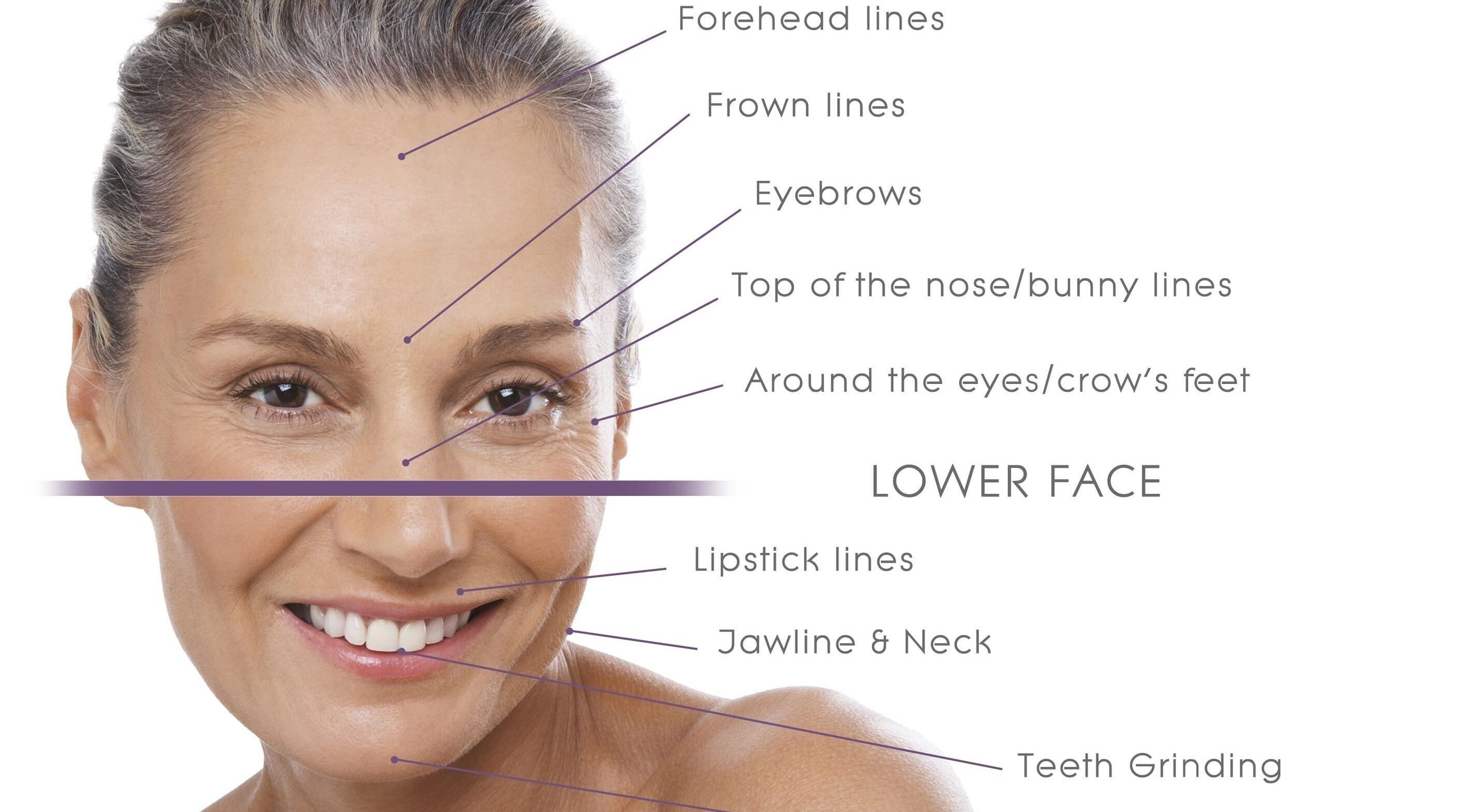 Facial lines diagram at NovaSkin, County Kilkenny, IE, highlighting treatment areas for skincare.