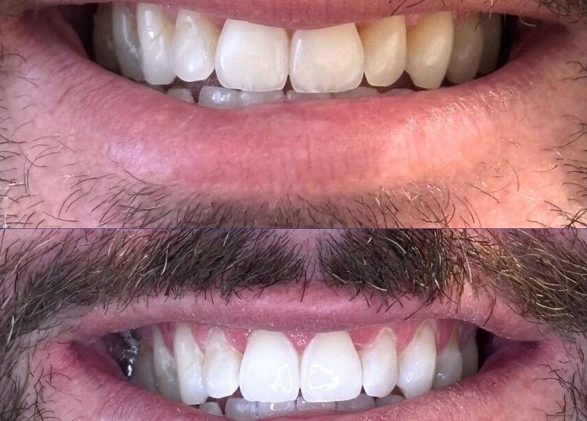 Before and after teeth whitening at White and Bright Teeth Whitening Studio, Brisbane City, Queensland, AU.