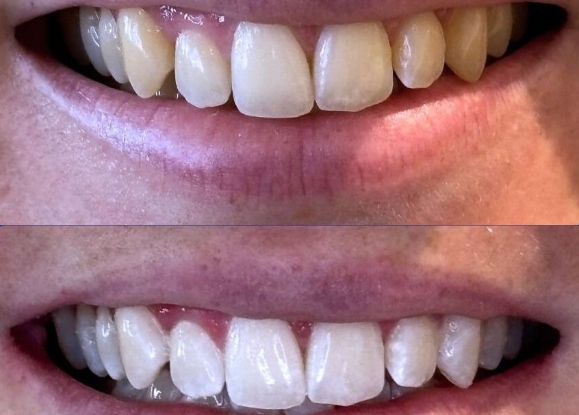 Before and after teeth whitening at White and Bright Teeth Whitening Studio, Brisbane City, Queensland, AU.