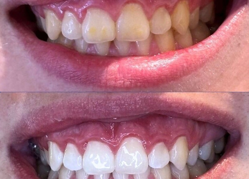 Before and after teeth whitening at White and Bright Teeth Whitening Studio, Brisbane City, Queensland, AU.