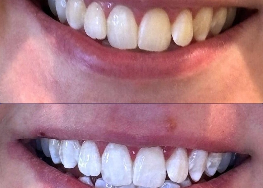 Before and after teeth whitening at White and Bright Teeth Whitening Studio, Brisbane City, Queensland, AU.