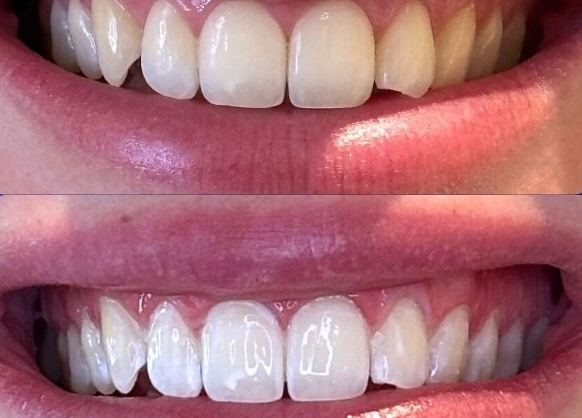 Before and after teeth whitening at White and Bright Teeth Whitening Studio in Brisbane City, Queensland, AU.