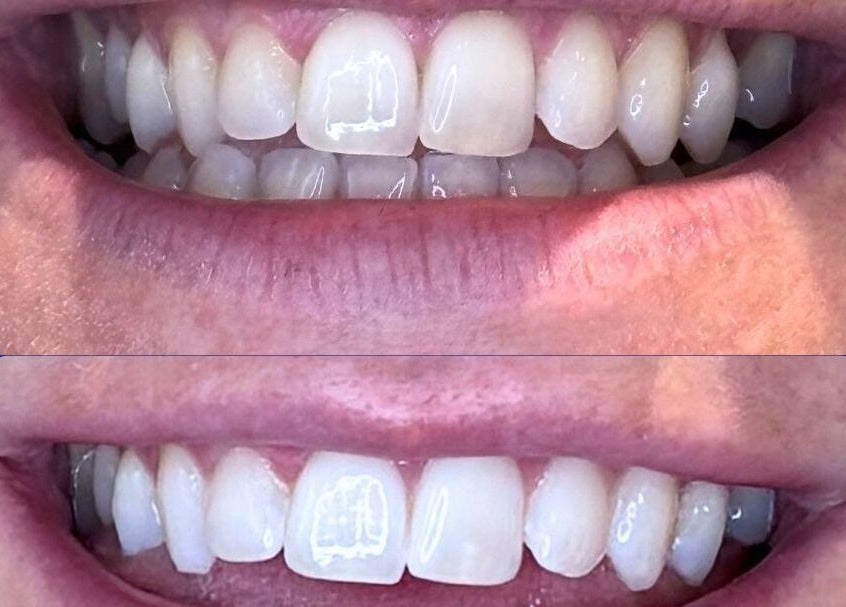 Teeth whitening results at White and Bright Teeth Whitening Studio in Brisbane City, Queensland, AU.