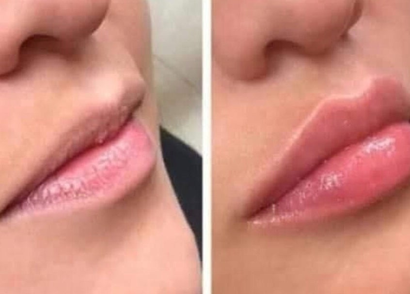 Before and after lip enhancement at Insta Aesthetics, Ashton-under-lyne, England, showcasing fuller lips.