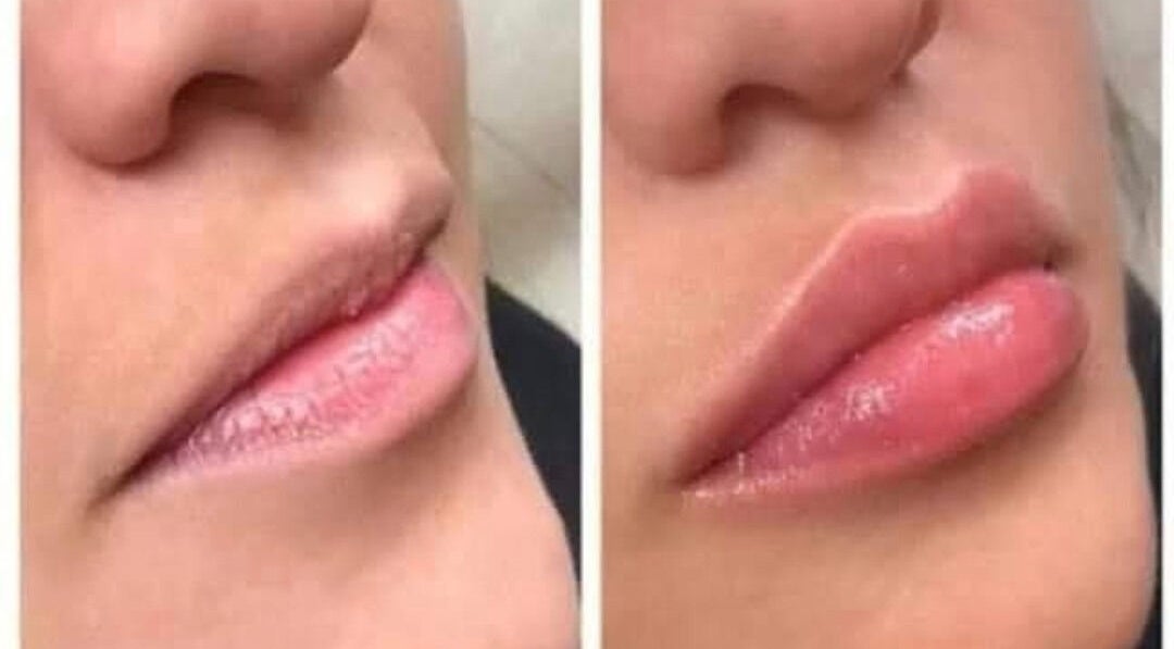 Before and after lip enhancement at Insta Aesthetics, Ashton-under-lyne, England, showcasing fuller lips.