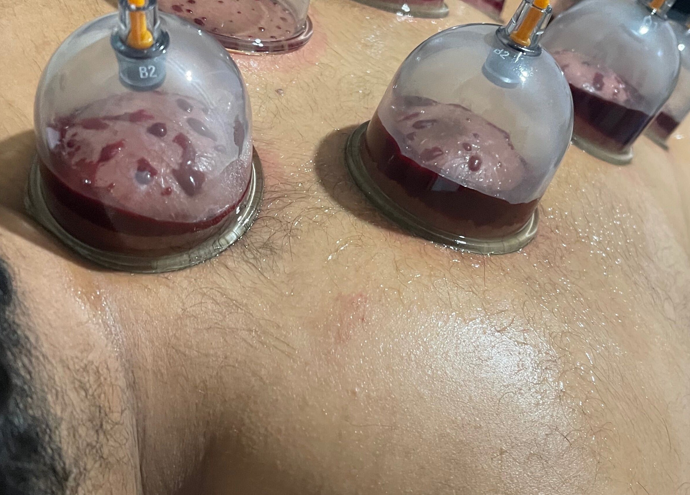 Cupping therapy session at Cupping By Hamza, Adlington, England, GB showing cups applied to skin.