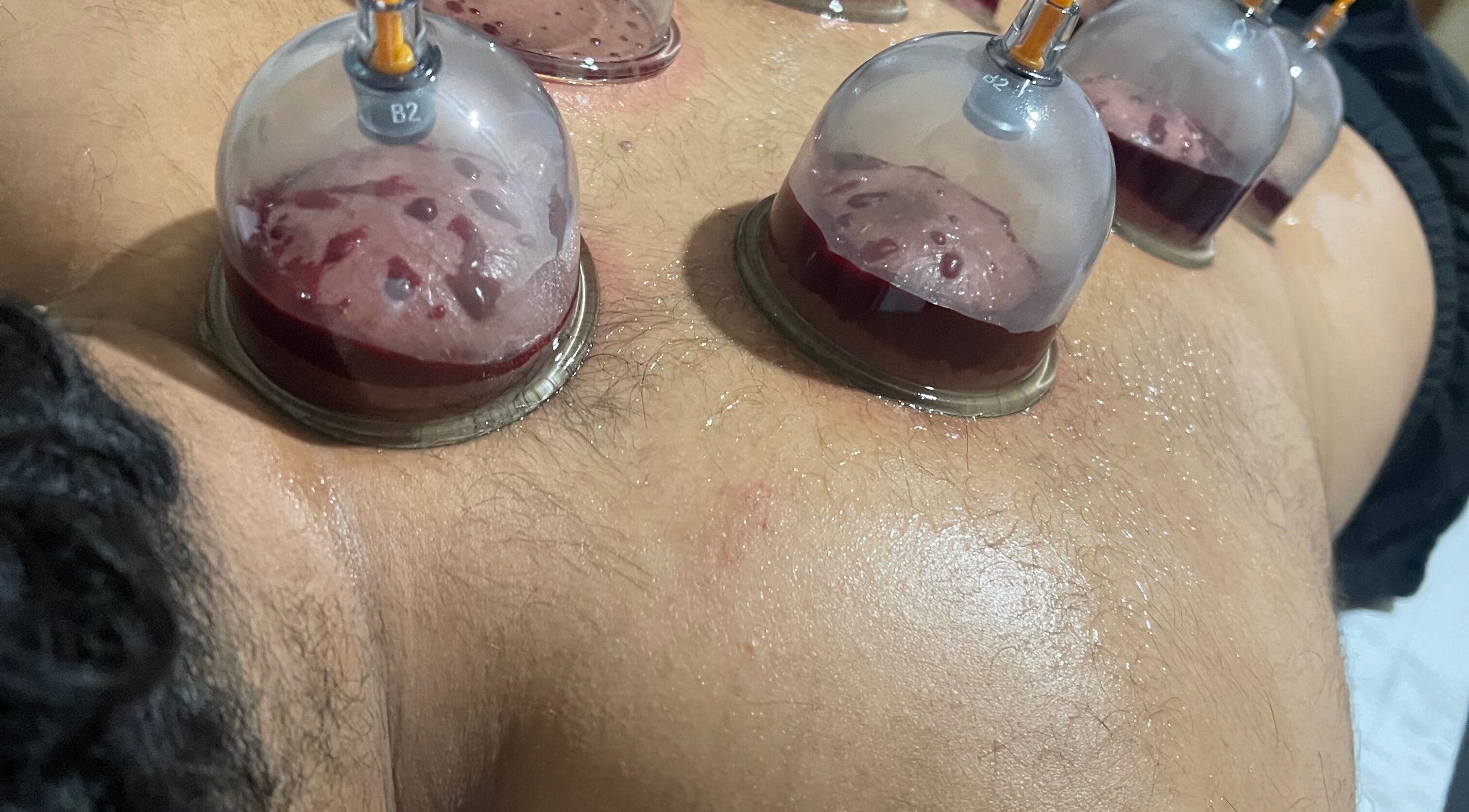 Cupping therapy session at Cupping By Hamza, Adlington, England, GB showing cups applied to skin.