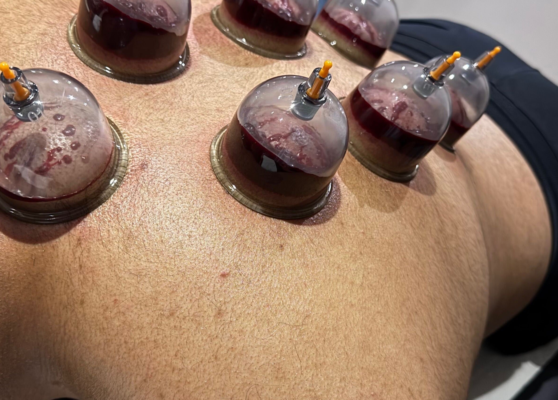 Cupping therapy on a back at Cupping By Hamza, Adlington, England, GB, showing glass cups in action.