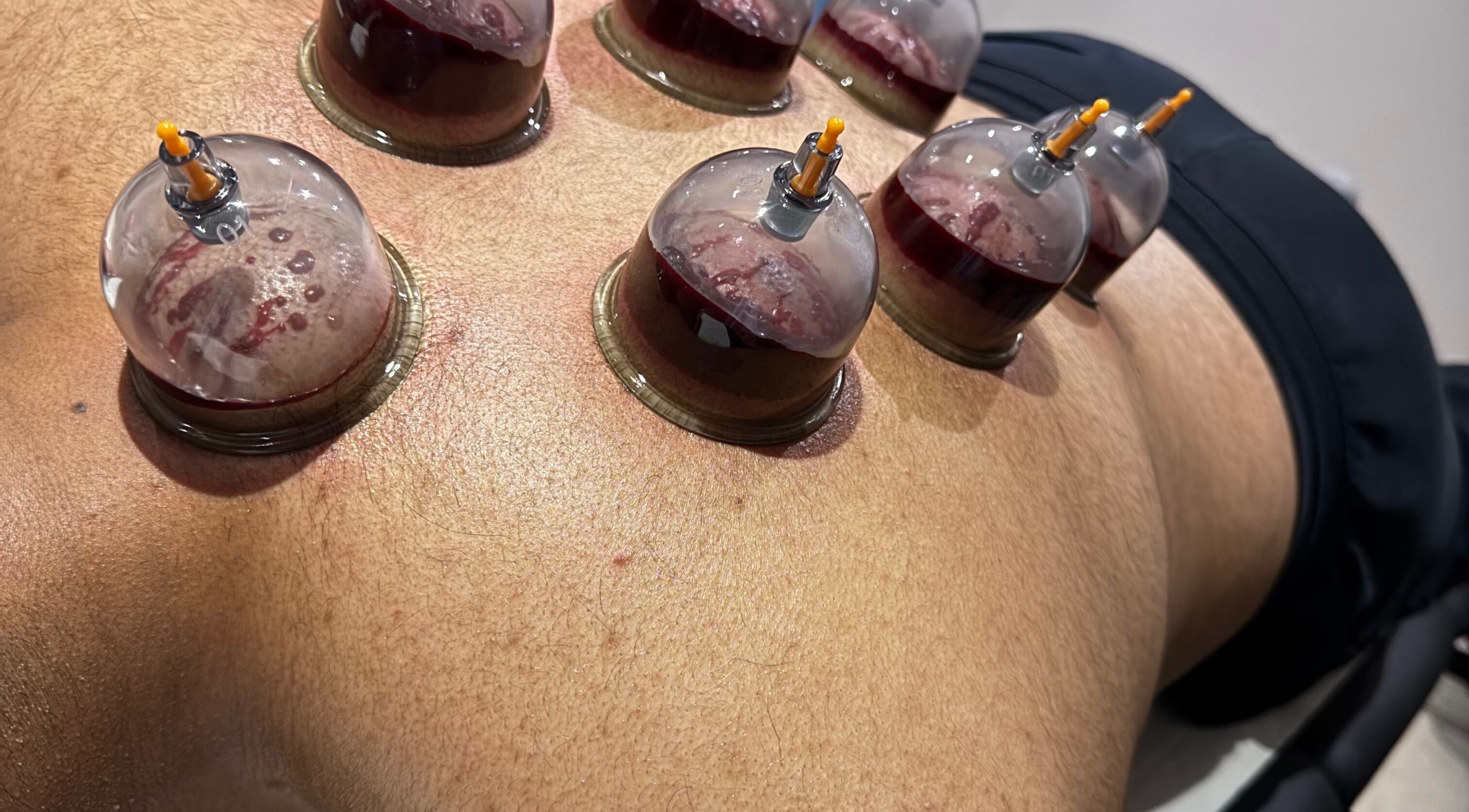 Cupping therapy on a back at Cupping By Hamza, Adlington, England, GB, showing glass cups in action.