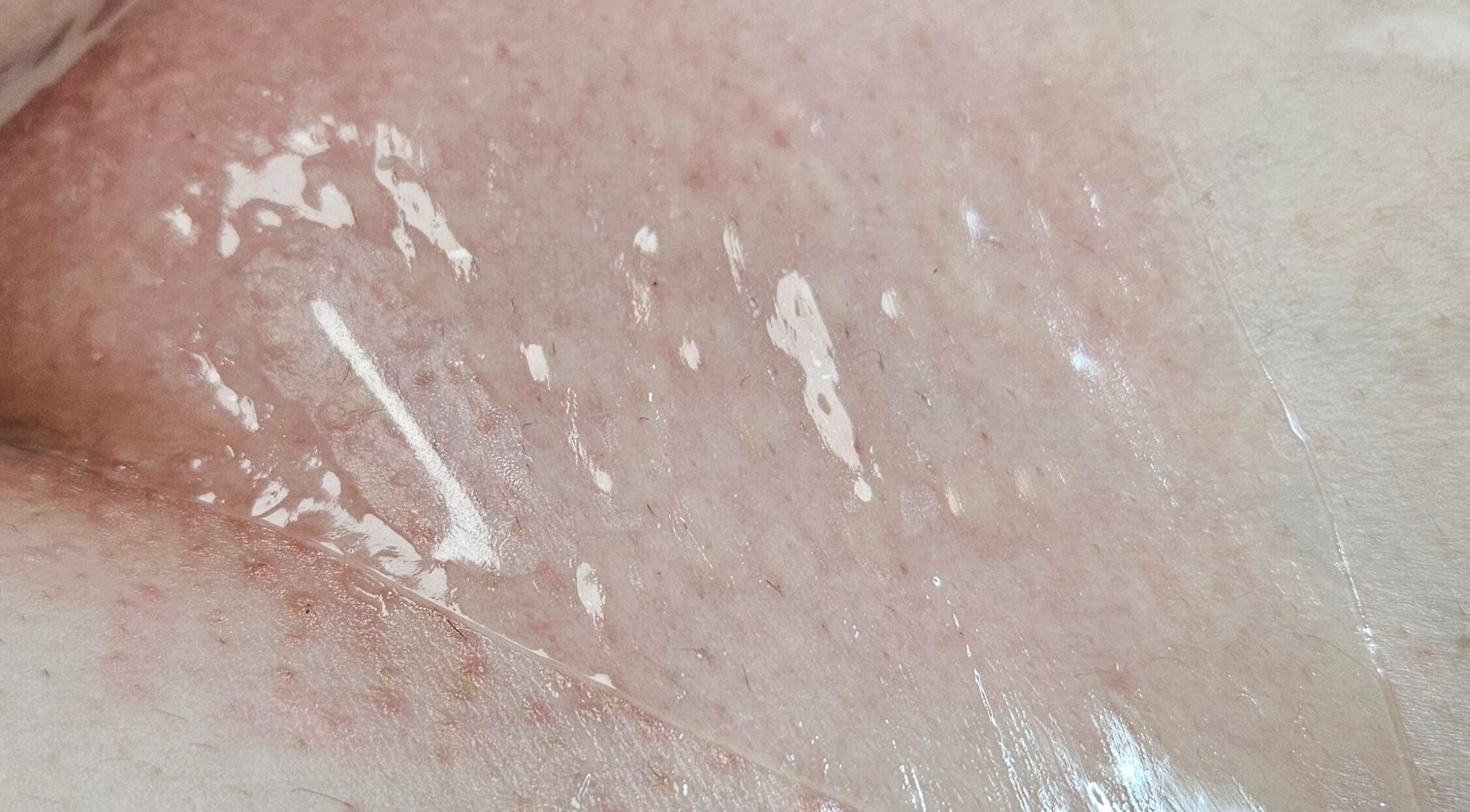 Skin rejuvenation treatment at IYL VIBRANT SKIN STUDIO, El Paso, Texas, US for a smooth glowing finish.