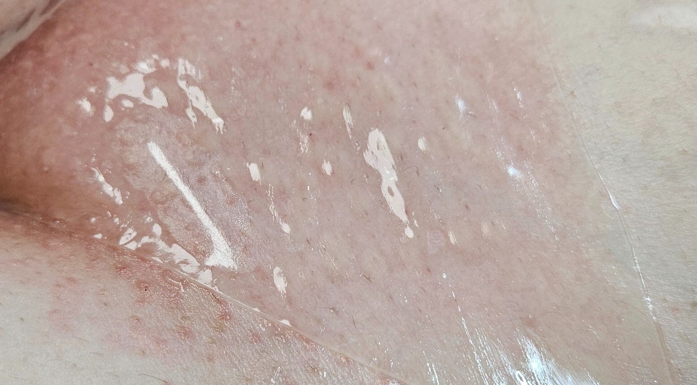 Skin rejuvenation treatment at IYL VIBRANT SKIN STUDIO, El Paso, Texas, US for a smooth glowing finish.