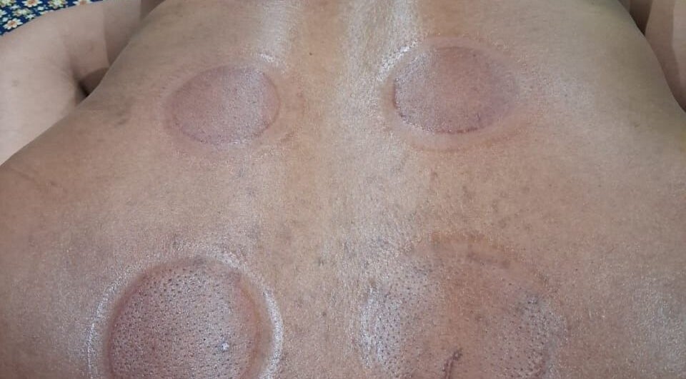 Cupping therapy session at Lilly Harmony & Sparkle, Sandton, ZA. Experience rejuvenation and relief.