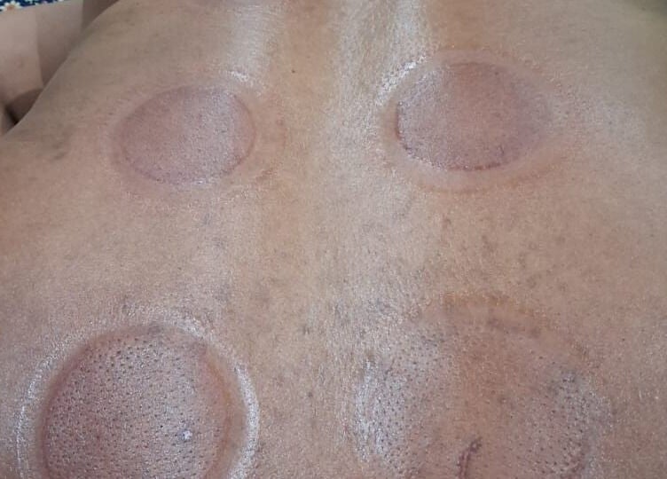 Cupping therapy session at Lilly Harmony & Sparkle, Midrand, Gauteng, ZA highlighting relaxation and wellness.