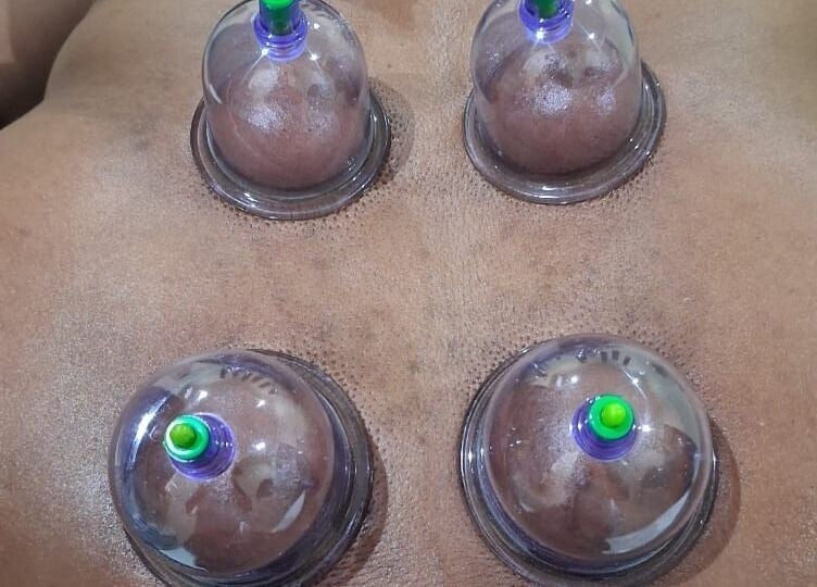 Cupping therapy session at Lilly Harmony & Sparkle in Midrand, Gauteng, ZA promoting relaxation and wellness.