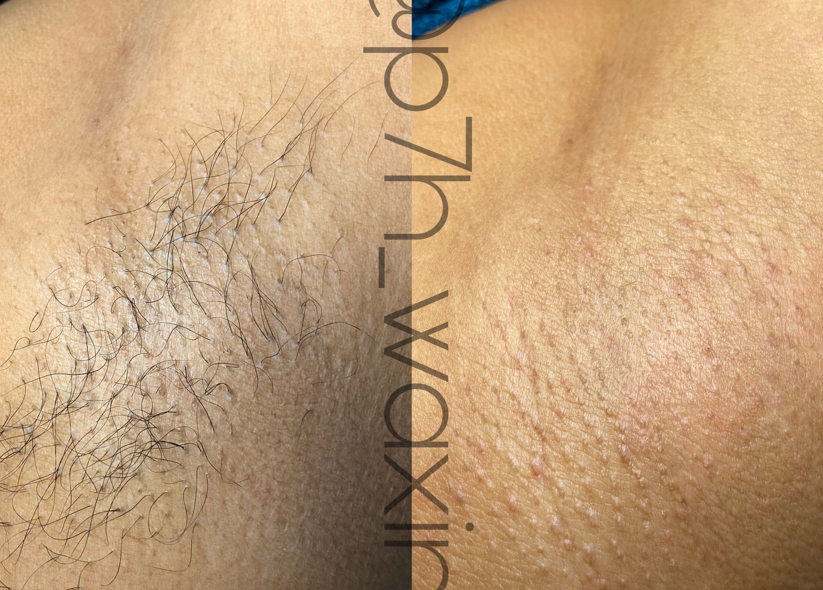 Before and after waxing at P7H by Poca7hontas, Paramaribo showcasing smooth skin results.