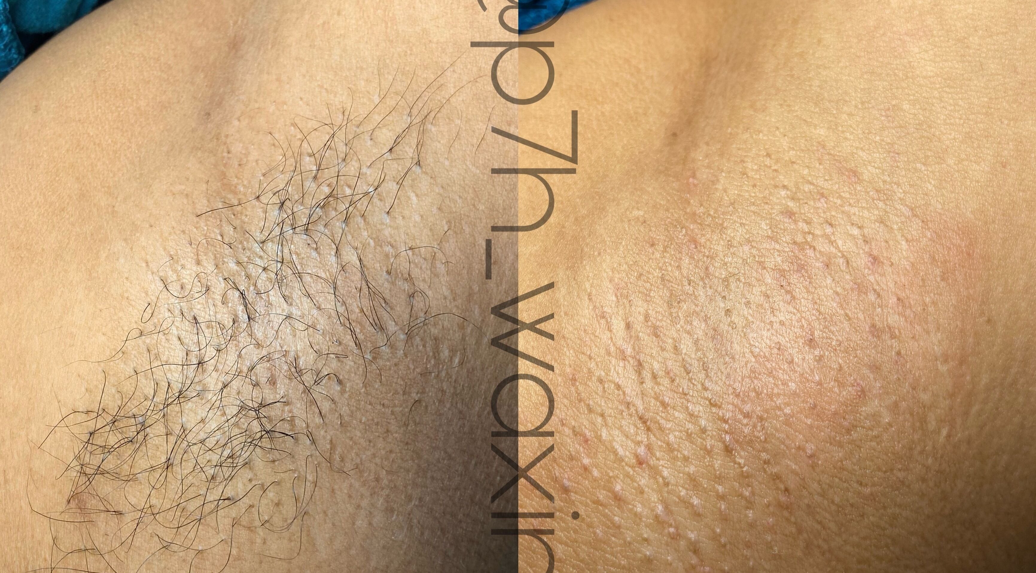 Before and after waxing at P7H by Poca7hontas, Paramaribo showcasing smooth skin results.