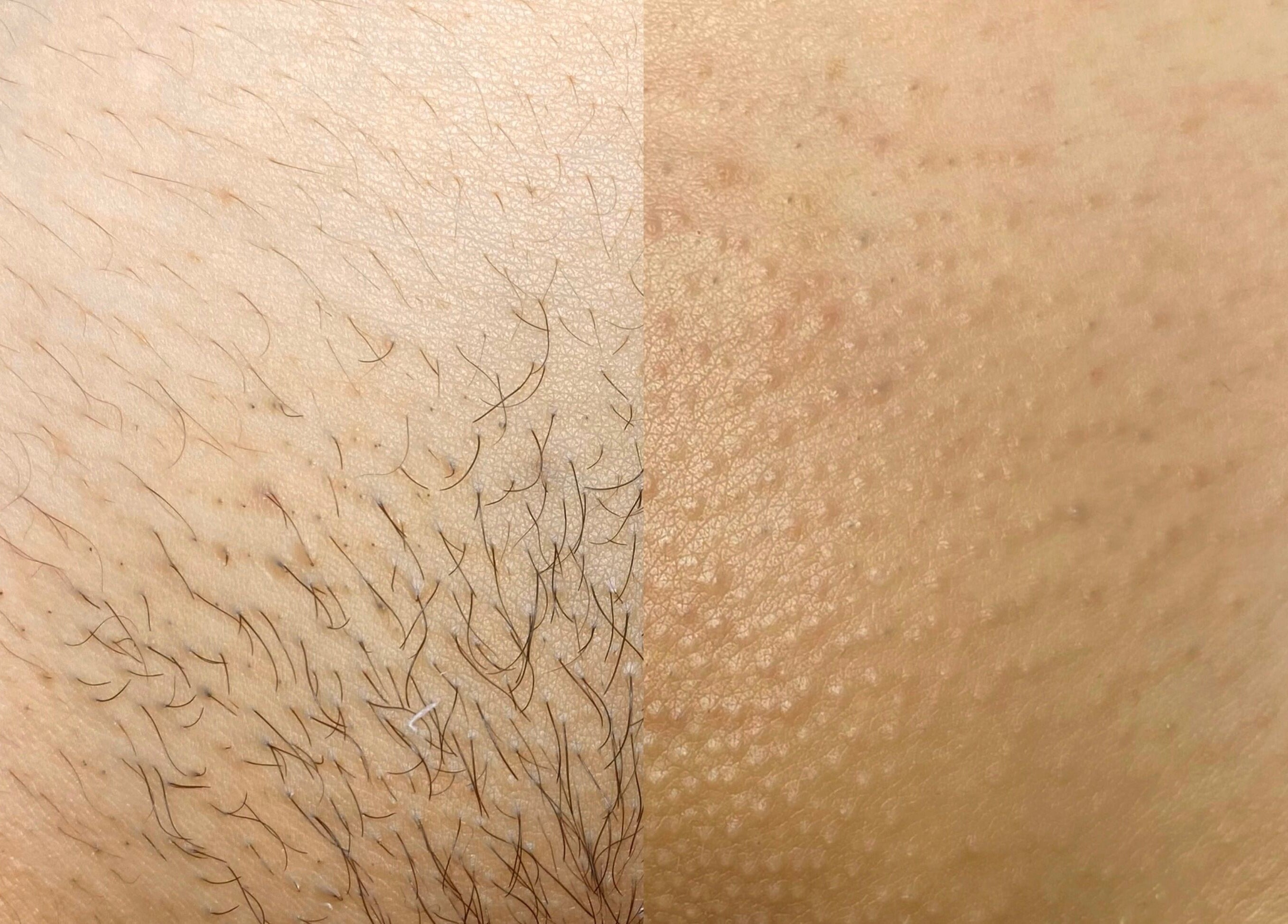 Hair removal results at P7H by Poca7hontas, Paramaribo, Paramaribo, SR. Smooth skin transformation.