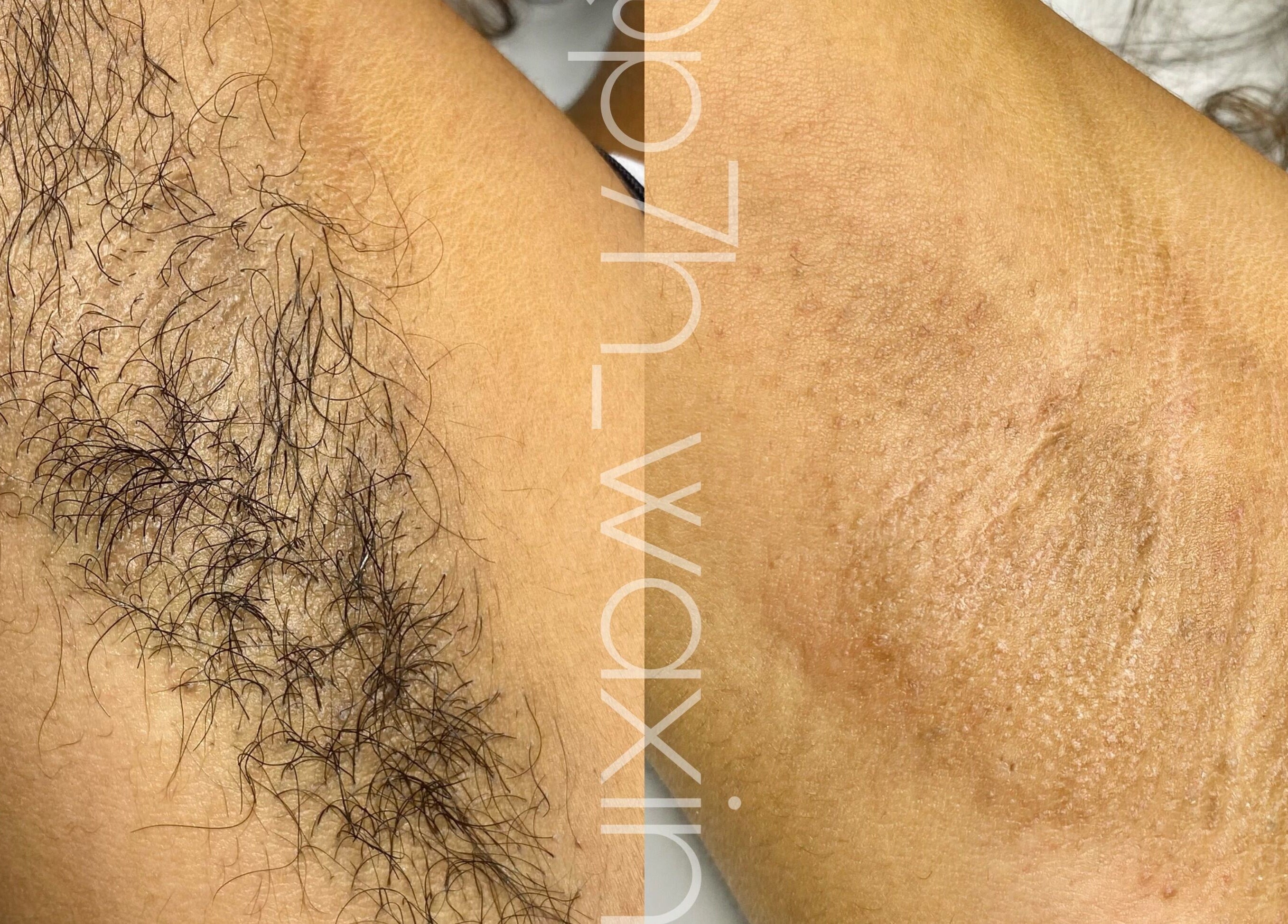 P7H by Poca7hontas waxing service in Paramaribo, SR, showing hair removal results.