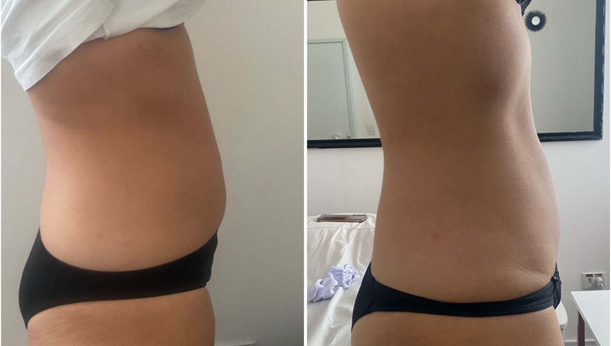 Antes e depois de tratamento na Beatriz Rocha estética integrativa, São Paulo, São Paulo, BR.