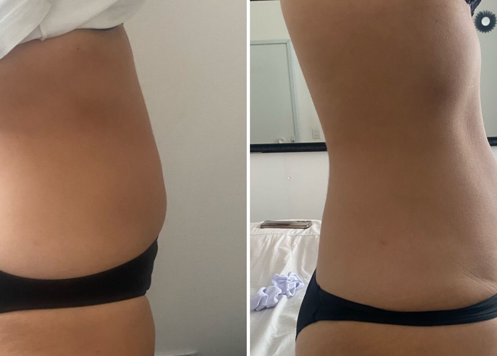 Antes e depois de tratamento na Beatriz Rocha estética integrativa, São Paulo, São Paulo, BR.