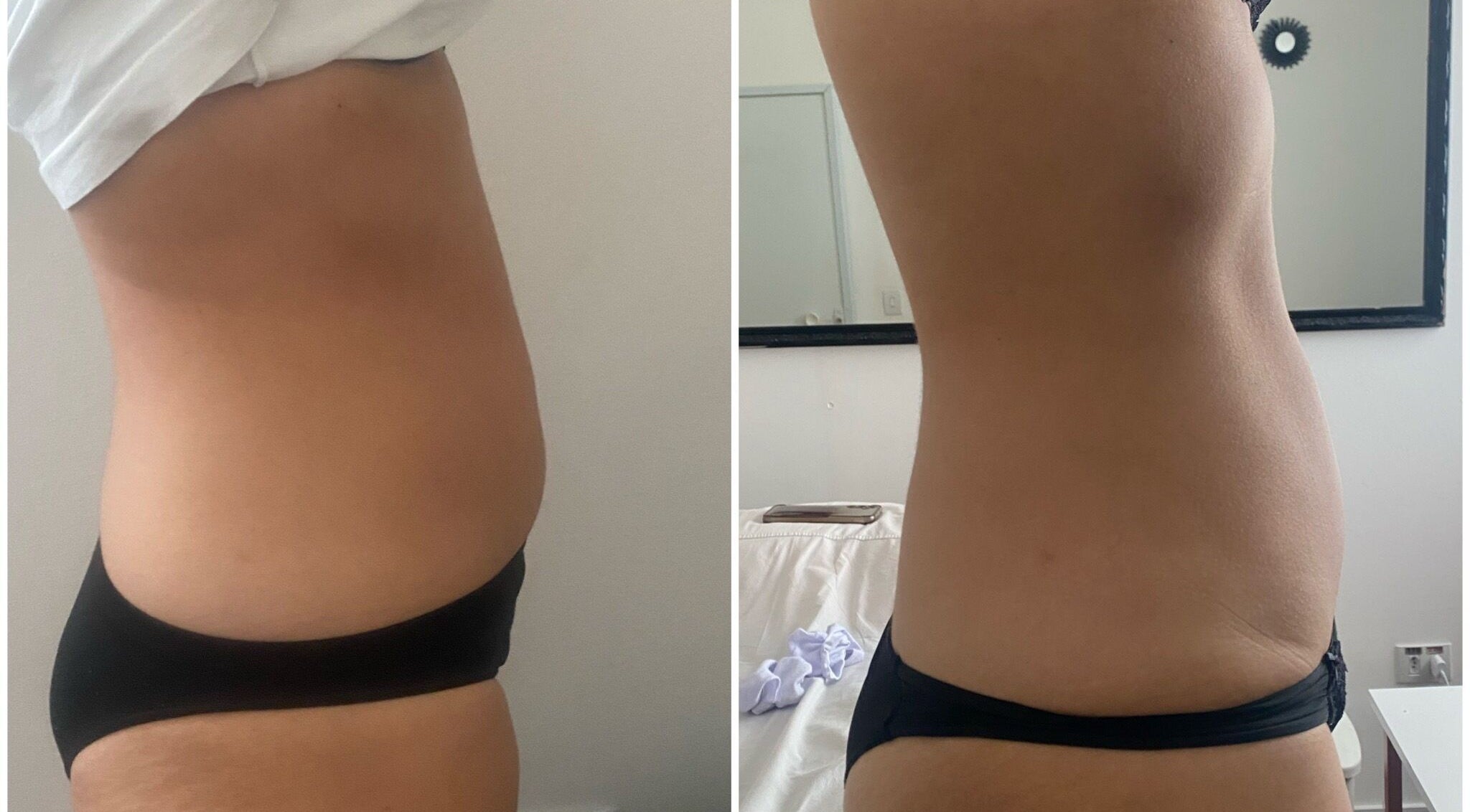 Antes e depois de tratamento na Beatriz Rocha estética integrativa, São Paulo, São Paulo, BR.