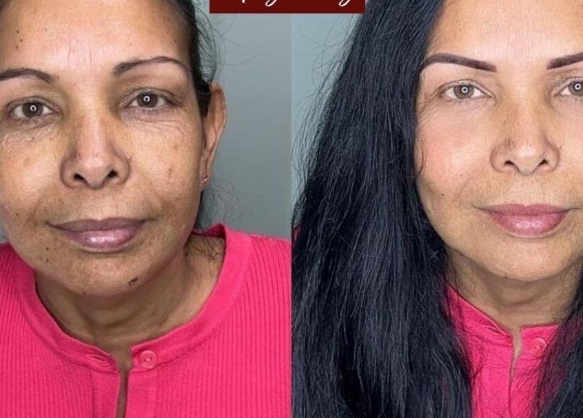 Antes y después de un tratamiento facial en Kerlys Beauty Geneve, Genève, Genève, CH.