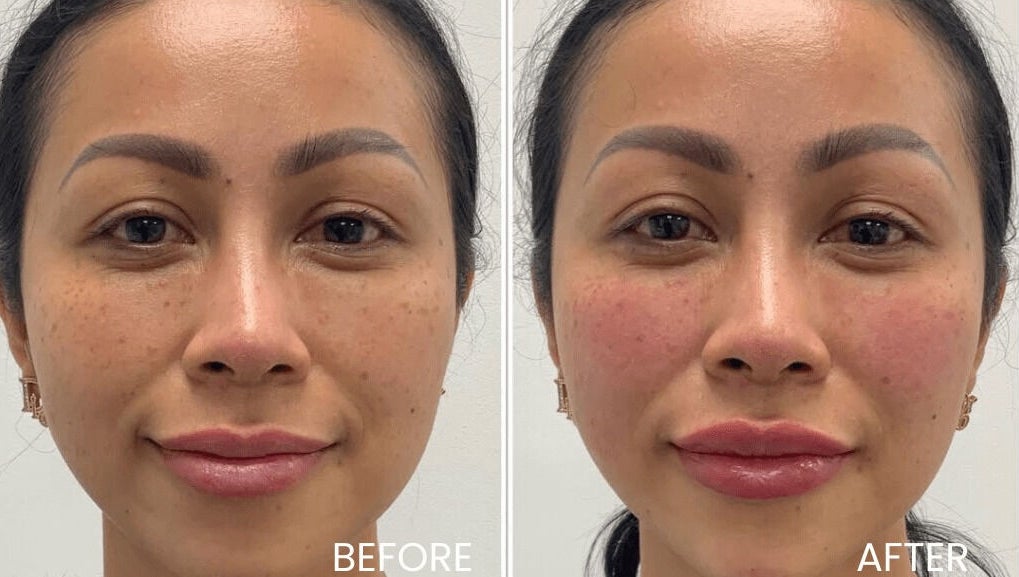 Before and after skin treatment at Aria Medical Aesthetics, Toronto, Ontario, CA, showcasing enhanced complexion.