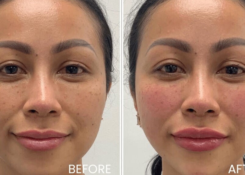 Before and after skin treatment at Aria Medical Aesthetics, Toronto, Ontario, CA, showcasing enhanced complexion.