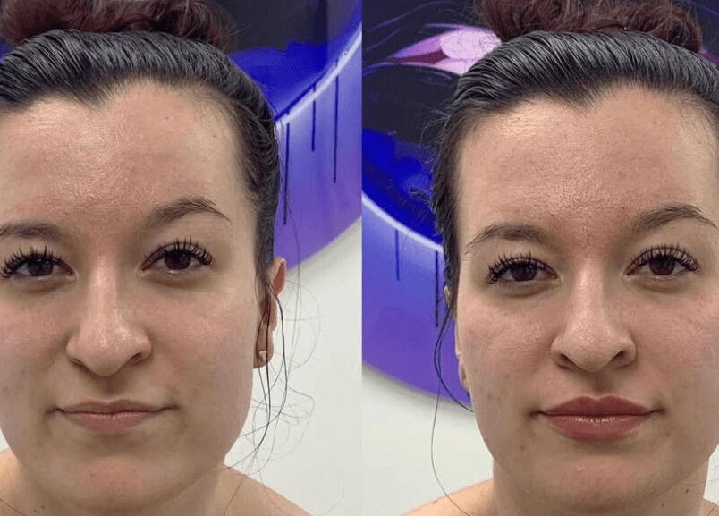 Before and after facial treatment at Aria Medical Aesthetics, Toronto, Ontario, CA, showing visibly smoother skin.