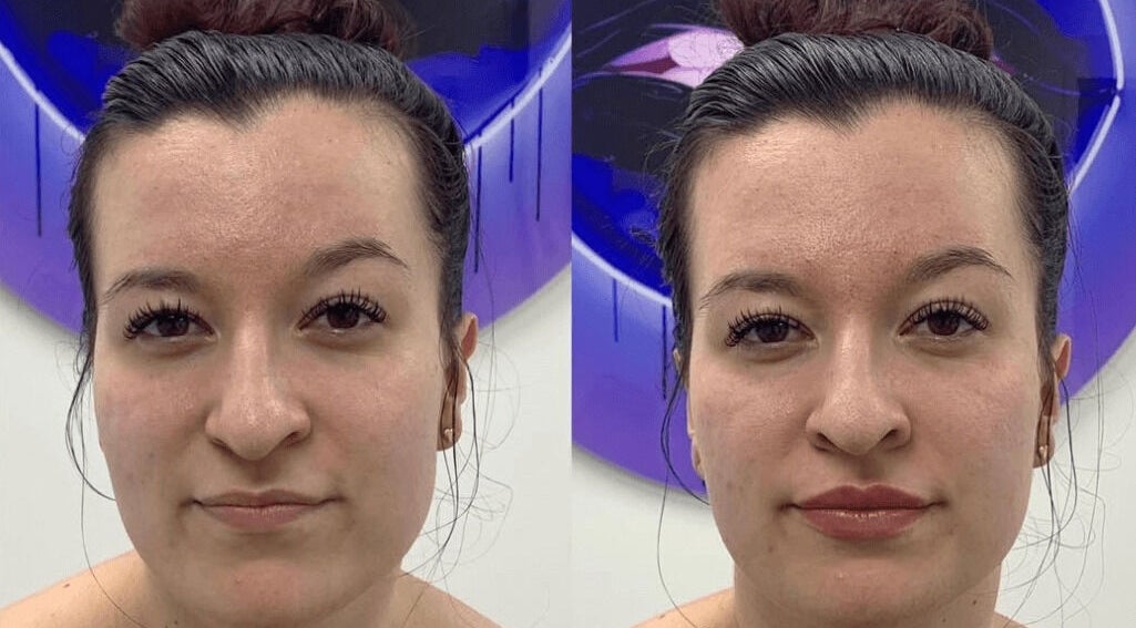 Before and after facial treatment at Aria Medical Aesthetics, Toronto, Ontario, CA, showing visibly smoother skin.
