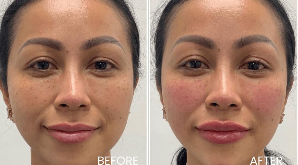 Before and after facial treatment at Aria Medical Aesthetics in Toronto, Ontario, CA showing improved skin texture.