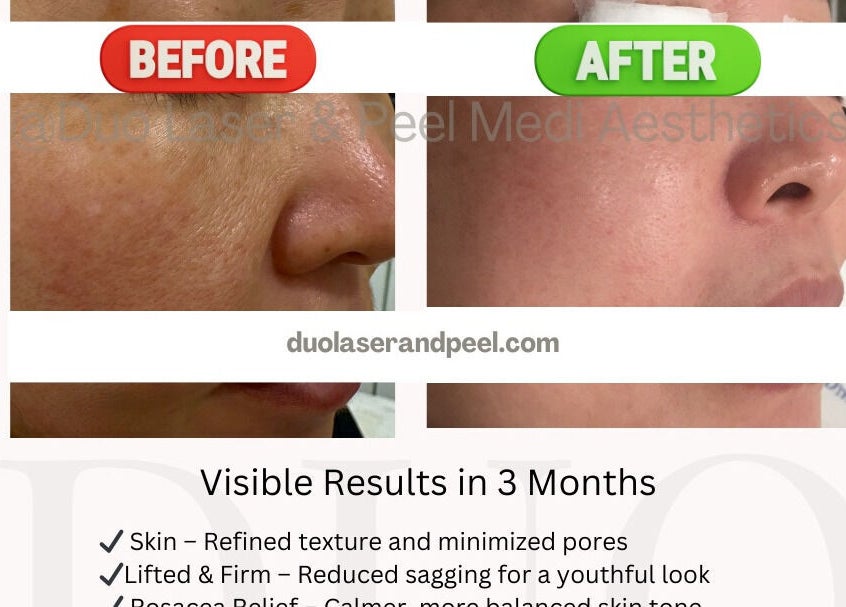 Before and after skin results at Duo Laser and Peel Medi Aesthetics, Coquitlam, British Columbia, CA.