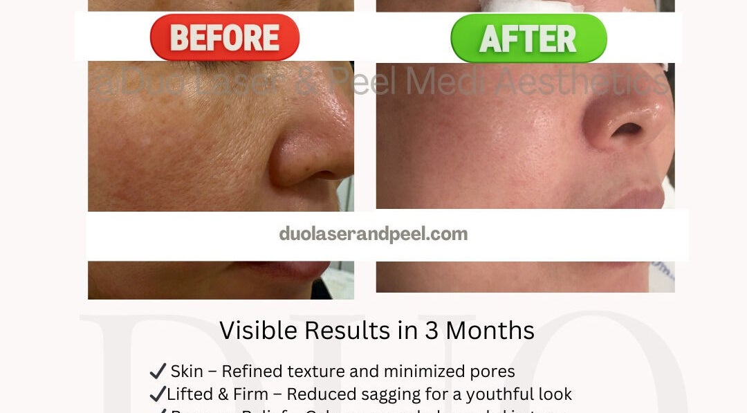 Before and after skin results at Duo Laser and Peel Medi Aesthetics, Coquitlam, British Columbia, CA.