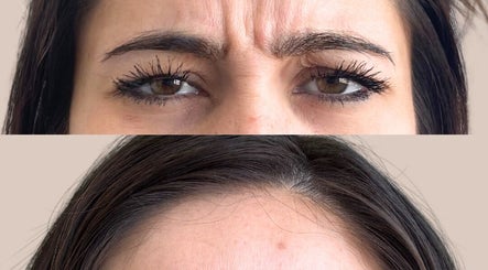 Before and after of forehead wrinkle treatment at Derma Noor Medical Spa in Garden Grove, California, US.