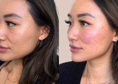 Before and after skin treatment at Derma Noor Medical Spa in Garden Grove, California, US.