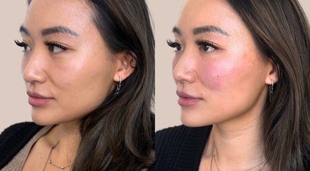 Before and after skin treatment at Derma Noor Medical Spa in Garden Grove, California, US.