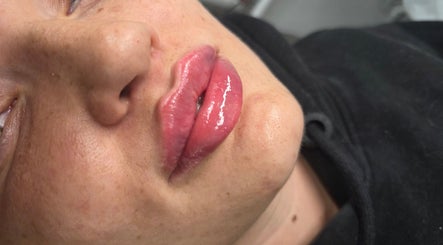 Lip enhancement at Aesthetics and Beauty by Natalia, Edinburgh, Scotland, GB. Achieve the perfect look.