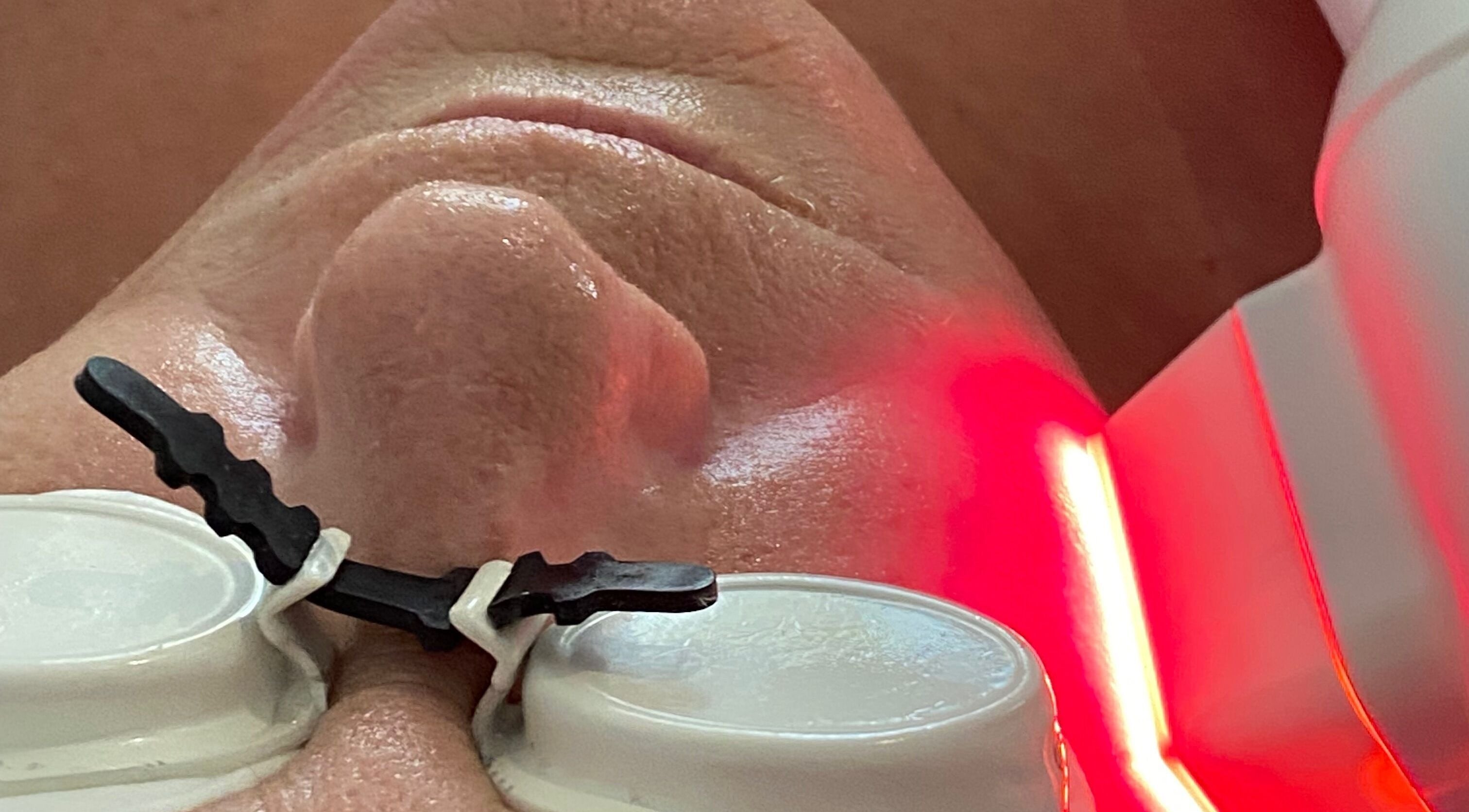 Facial laser treatment at Simply BeYoutiful, Cape Town, Western Cape, ZA offers rejuvenating skin therapy.