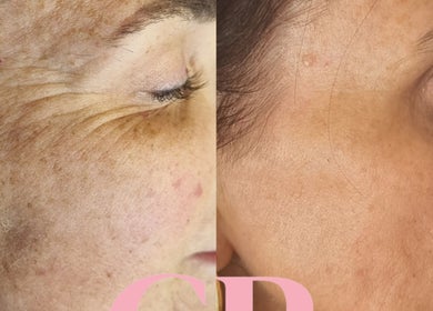 Before and after skin treatment at Healing Hands Beauty, Randfontein, Gauteng, ZA, showing improved skin texture.