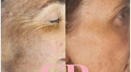 Before and after skin treatment at Healing Hands Beauty, Randfontein, Gauteng, ZA, showing improved skin texture.