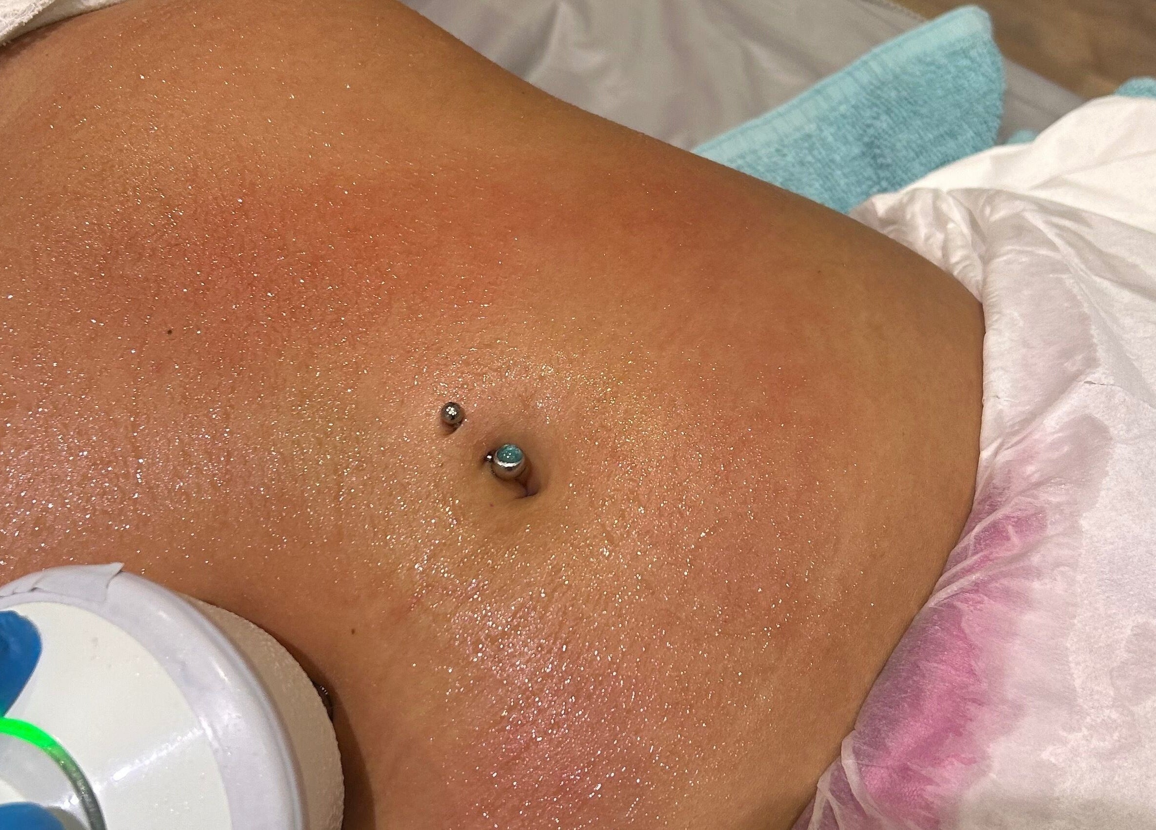 Laser skin treatment in progress at Fadeaway Laser Clinic, Southampton, England, GB.