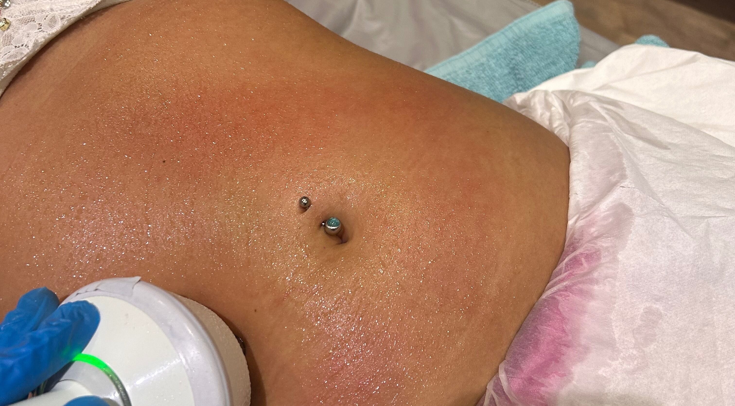 Laser skin treatment in progress at Fadeaway Laser Clinic, Southampton, England, GB.