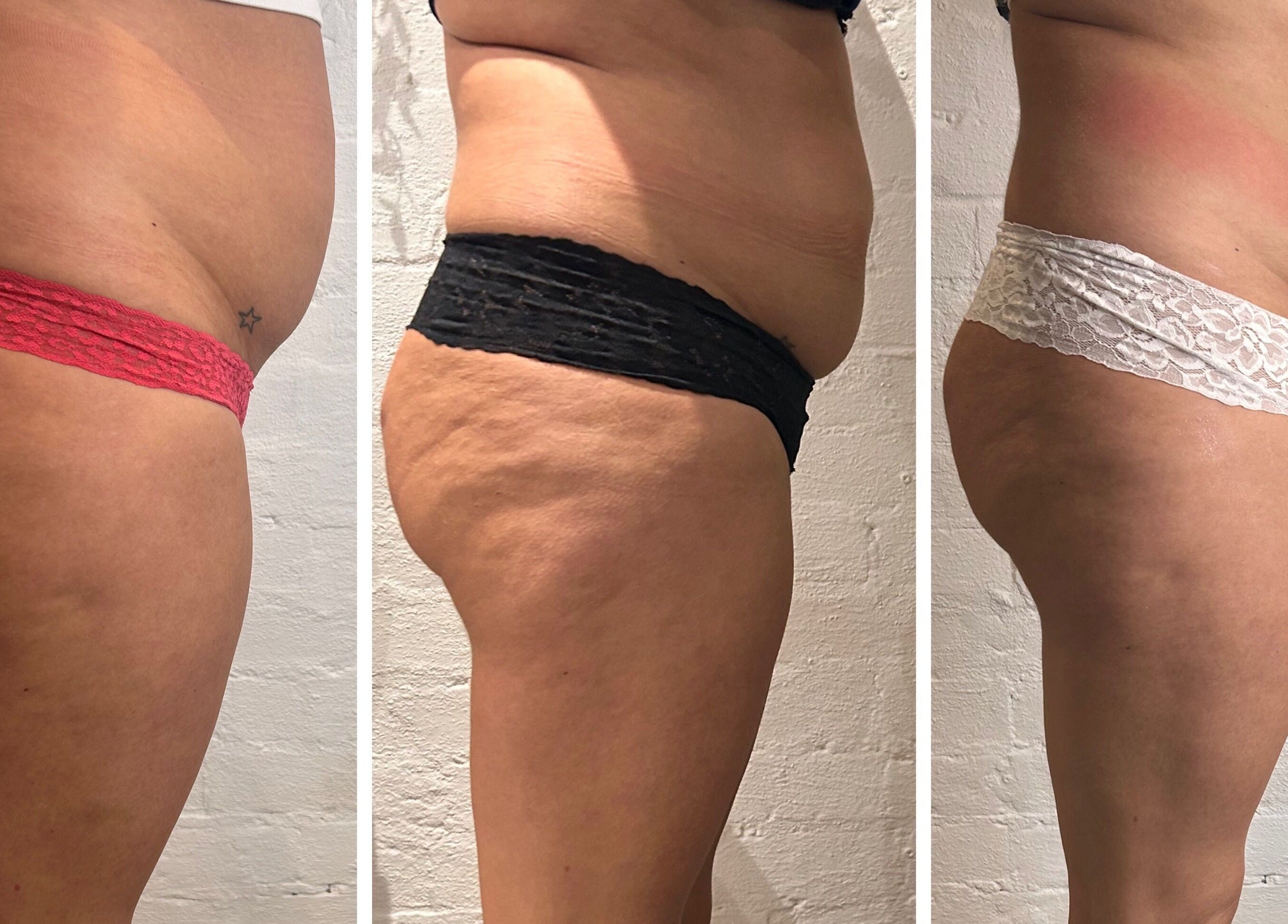 Body contouring results at Fadeaway Laser Clinic in Southampton, England, GB, showcasing before and after progress.