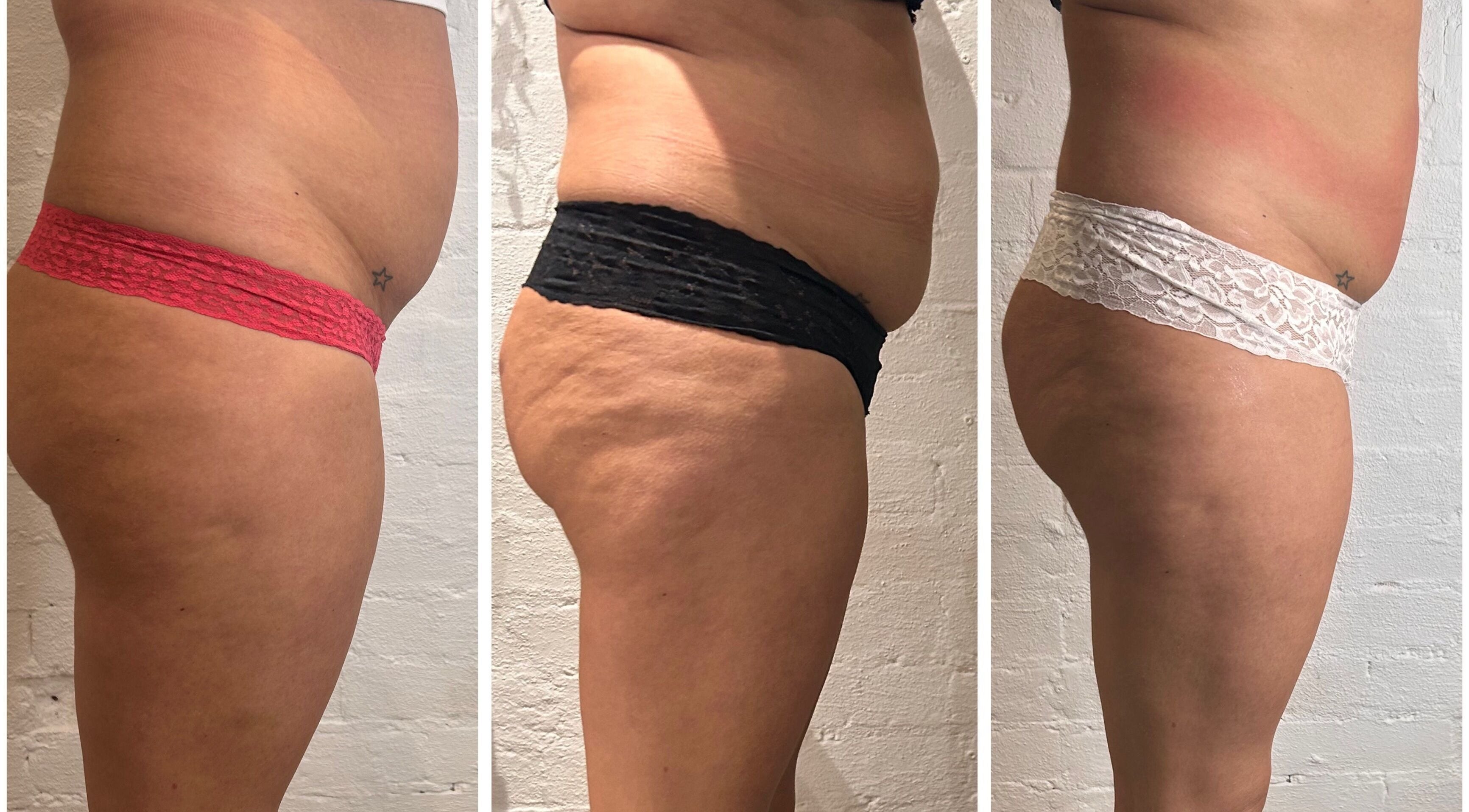 Body contouring results at Fadeaway Laser Clinic in Southampton, England, GB, showcasing before and after progress.
