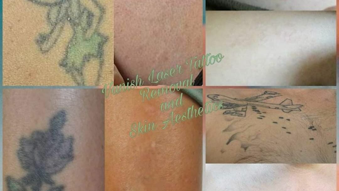 Vanish Ink  Laser Tattoo Removal