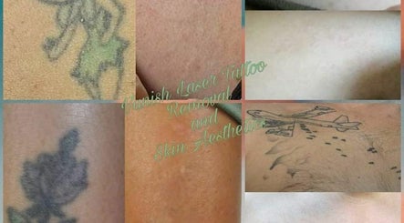 Vanish Laser Tattoo Removal and Skin Aesthetics – obraz 2
