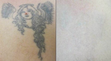 Vanish Laser Tattoo Removal and Skin Aesthetics 3paveikslėlis