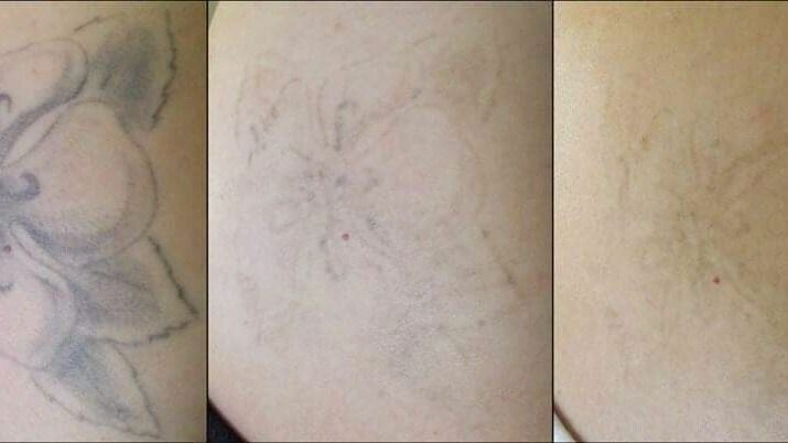 Laser Tattoo Removal  Ageless Medical  Premier Medspa serving Weston  Pembroke Pines and Davie