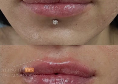 Lip enhancement results at Aesthetically Yours, Poynton, England, GB. Stunning transformation showcasing fuller lips.