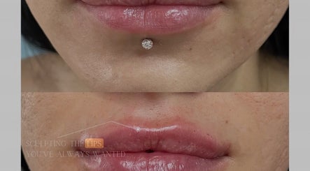 Lip enhancement results at Aesthetically Yours, Poynton, England, GB. Stunning transformation showcasing fuller lips.